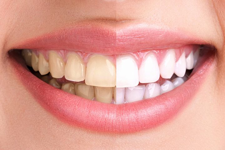 Apple Cider Vinegar for Teeth Whitening - Uses, Tips and Precautions