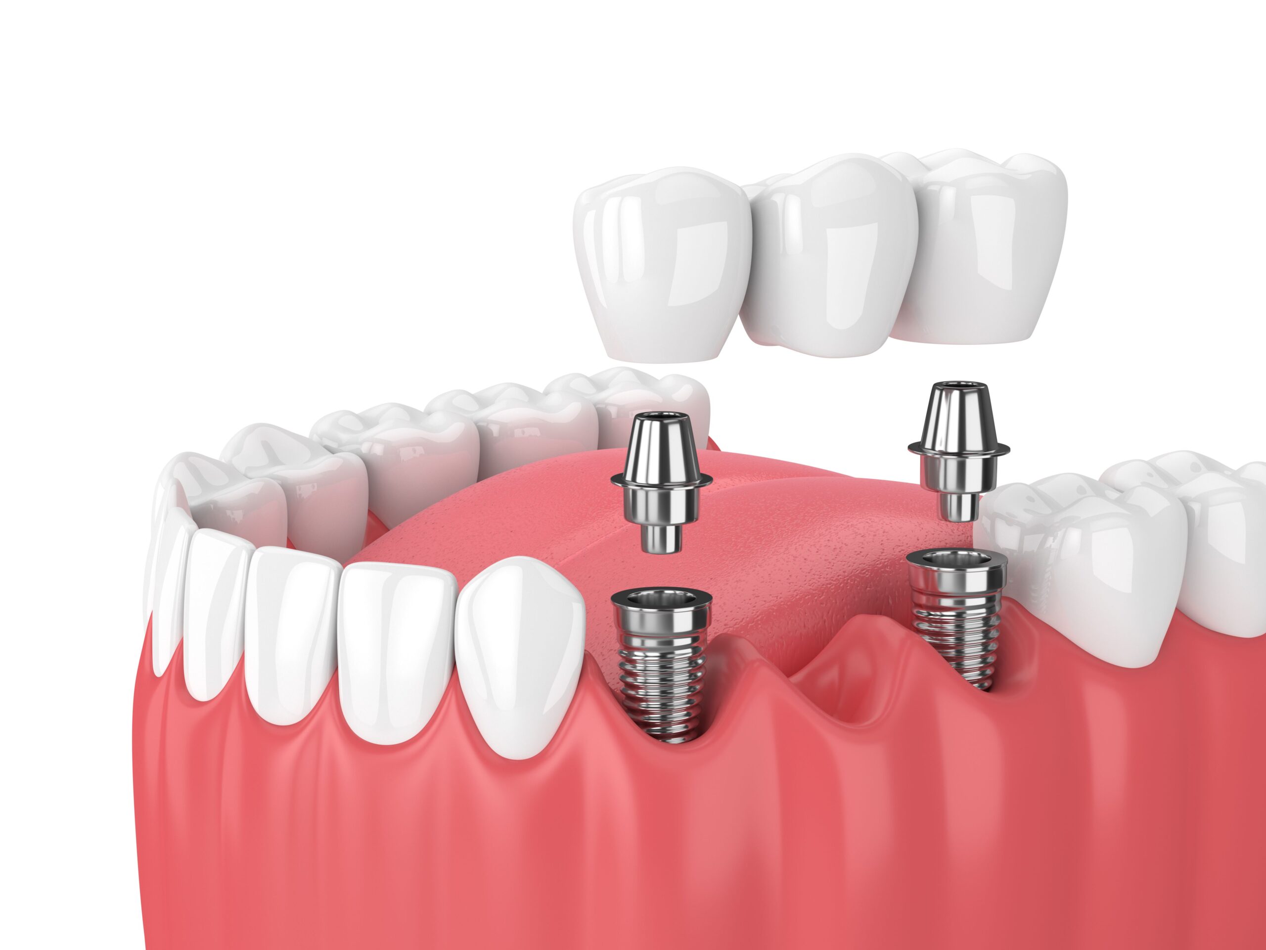 Implant Supported Bridge