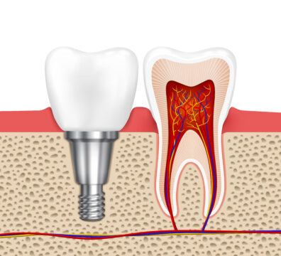 Healthy teeth and dental implant. Implant tooth, health tooth medical dentistry, vector illustration