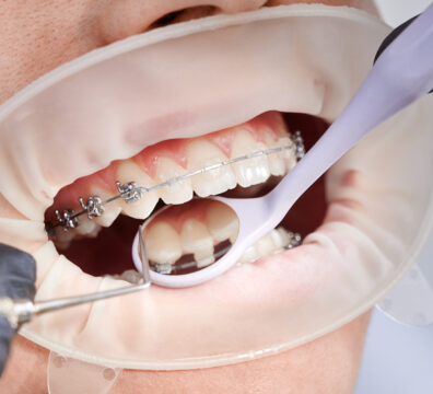 Close up of orthodontist placing orthodontic brackets on patient teeth. Person with cheek retractor and metal braces on teeth having dental procedure in clinic. Concept of orthodontic treatment.